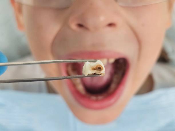 Best Emergency Treatment for Dental Infections or Abscesses in Trumbull Center, CT